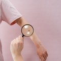 U Srbiji godišnje 250 ljudi premine od melanoma, sunce i solarijumi su štetni