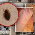 Kad ovaj insekt ujede kreće pravi pakao: Telo se odmah ospe, a evo koji simptomi su znak da morate hitno kod lekara