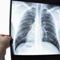 Rak pluća i inovacije u lečenju: Šta su to KRAS inhibitori?