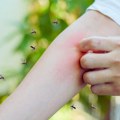 Zaboravite češanje: Ovaj brzi trik ublažava svrab od ujeda komarca