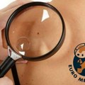 Prevencija i rano okrivanje melanoma