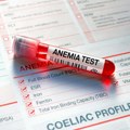 Koji su znaci i simptomi anemije uzrokovane nedostatkom gvožđa