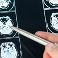 Litijum iz hrane, ne za baterije – novi saveznik u borbi protiv Alchajmera