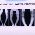 Ako dete ima ovakve noge, to je siguran znak retke bolesti: Dr Čuturilo: "Mi to vidimo pravo s vrata" (foto)