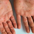 Vraćaju se morbile Hitno se oglasio Batut, evo koliko je registrovanih slučajeva od početka godine