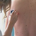 Udruženje dermatovenerologa Srbije: Tokom besplatnih pregleda otkriveno 32 melanoma