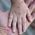 Raste broj zaraženih u Srbiji od opasne bolesti