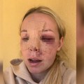 Mlada lepotica doživela jezivu povredu na treningu! Sportistkinja slomila skoro sve kosti na licu, pa snimila video…