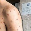 Opasna zaraza hara Srbijom! U okviru porodične epidemije u Nišu, obolelo i dvoje dece