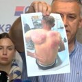 "Repetirali mu pištolj prislonjen uz glavu" Dr Elek preneo jezive detalje prebijanja koje mu je pretučeni Srbin Nenad Rašković…