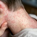 "Nije moguće okončati epidemiju malih boginja": Globalna pretnja po javno zdravlje
