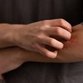 Naučno potkrepljen trik koji ublažava svrab bolje od češanja
