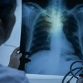 Rak pluća koji se najčešće dijagnostikuje nakon metastaza: Simptomi koji ukazuju gde se proširio