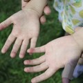Atopijski dermatitis: Više od kožne bolesti, alarmantni podaci o kvalitetu života pacijenata