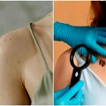 Besplatni dermatološki pregledi u 13 gradova Akcija počinje danas i traje do 1. juna