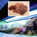 U Srbiji godišnje 250 ljudi premine od melanoma! Sunce i solarijumi mogu štetiti koži