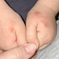 Crvenilo i ispucala koža: Više od 1.600 dece u vrtićima u Beogradu ima problem sa šakama