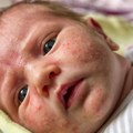 Važno oglašavanje "Batuta": Epidemijsko javljanje malih boginja može se sprečiti kolektivnim imunitetom