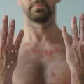 Dve osobe zaražene majmunskim boginjama u Severnoj Makedoniji dobro, nema novih slučajeva