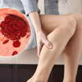 Sve o trombofiliji: Stanje koje nosi rizik od moždanog udara i pobačaja, a mnogi ne znaju da ga imaju