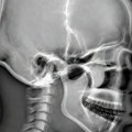 U lobanji pronađen dosad nepoznati organ: Da li će se rak mozga lečiti ubrizgavanjem gela?