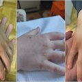 "Suve ruke, ispucala koža i crvenilo nalik ekcemu": Javila nam se mama iz Kragujevca, njeno dete ima iste simptome kao i deca…