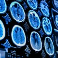 Nova metoda skeniranja mozga predviđa pojavu Alchajmerove bolesti i devet godina ranije