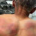Doktor o stanju Srbina pretučenog kod Zubinog Potoka: "U šok sobi je, ima povrede na leđima, grudnom i po glavi"