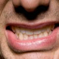 Simptom u ustima javlja se kod skoro svih pacijenata sa Parkinsonovom bolešću