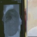 Nove terapije za rak dojke o trošku države Dr Žegarac: "Kada se pacijentkinja javi na vreme, karcinom rešavamo maltene dnevnom…
