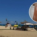 "Nemam pojma šta se desilo": Kroz smeh pokazao jezivu kožu posle letovanja, ovo može da bude opasno po život