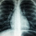 Medicinski fenomen: Čovek osam godina živeo s nožem u grudima, a da to nije znao