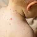 Potvrđen slučaj morbila u Srbiji: Vakcinacija ključna za zaštitu dece
