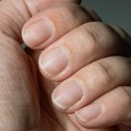 "Odličan" način da prepoznate visok nivo holesterola: Nokti mogu da ga odaju, obratite pažnju na dve stvari