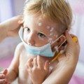 Potvrđeno, još jedan slučaj malih boginja u Beogradu: Oboleo dečak, osam mu je godina a nijednu vakcinu nije primio?!