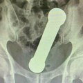 Žalio se na bolove Lekari zanemeli kad su videli rendgenski snimak: Iz rektuma mu izvađen teg od 2 kilograma!