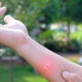 Povećan broj uboda insekata: Izazivaju alergijske reakcije na koži