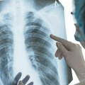 U Rusiji otkrivena tuberkuloza otporna na nekoliko lekova