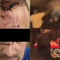 Objavljena fotografija čoveka kojeg je flašom udario Karlik Džons