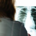 Osam godina živeo sa nožem u grudima: Lekari ostali u čudu kad su saznali jedan detalj, evo kako je sečivo završilo u njemu…