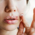 Херпес на усни: Све што би требало да знате