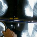 Svaki osmi slučaj raka u svetu povezan sa infekcijama koje mogu da se spreče
