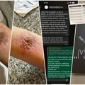 Nišlijka otišla u privatnu kliniku da skine fleke od sunca pa dobila jezive opekotine od lasera! Prešla sam prstom, osetila…