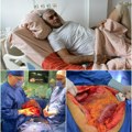 Čoveku iz stomaka izvadili Tumor težak 10 kilograma o podvigu hirurga sa Instituta za onkologiju Vojvodine dugo će se…