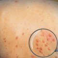 Deca najbrojnije žrtve epidemije koja je već odnela 1.000 života: Mališane kosi "zaboravljena" zarazna bolest!