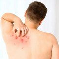 Богиње и хепатитис се шире бечом! Власти издале хитно упозорење