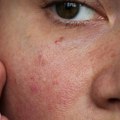 Da li i vi imate "jesenje lice"? Dermatolog upozorava, ovo nikako ne smete ako vam koža plane kad zahladni