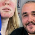 Rozacea - uporno crveni obrazi i kapilari koji ne prolaze: Dr Lukić skreće pažnju na opasne greške i objašnjava kako smiriti…