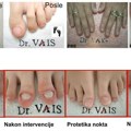 DR VAIS: Rešite se gljivičnih infekcija noktiju