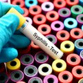 Sifilis, hlamidijaza, AIDS: Polno prenosive bolesti u Srbiji u porastu iz godine u godinu